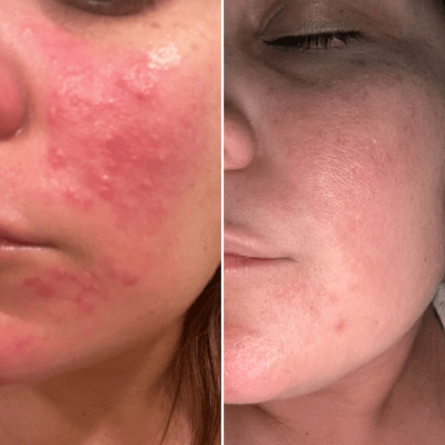 ACNE FACIALS